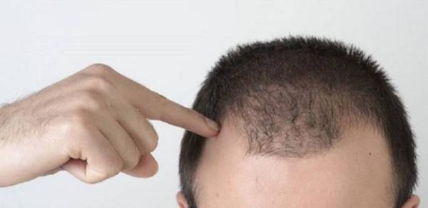 ریزش مو در مردان جوان به چه دلیل می باشد؟